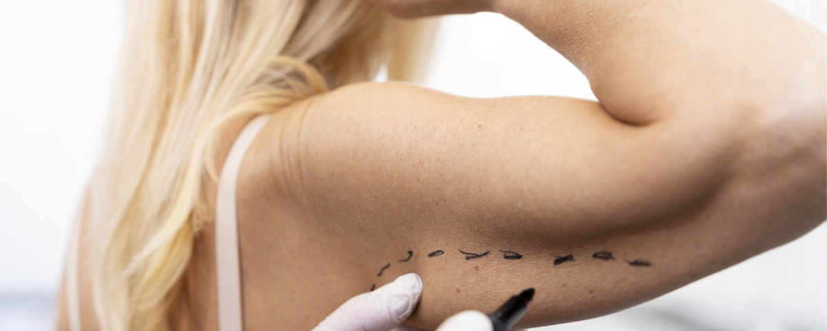 Toda cirugía deja cicatrices. Siempre que se corta la piel, los tejidos sanan dejando una cicatriz. Los cirujanos plásticos las hacemos en sitios que se puedan esconder o camuflar y manejamos los tejidos de forma que cicatricen lo mejor posible.